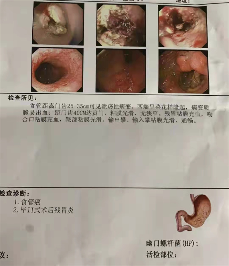 光华捷报胃癌术后再发长距离食道癌碘125粒子支架放置成功