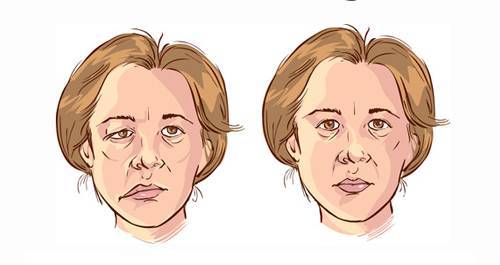 不可小觑的面子周围性面瘫知多少