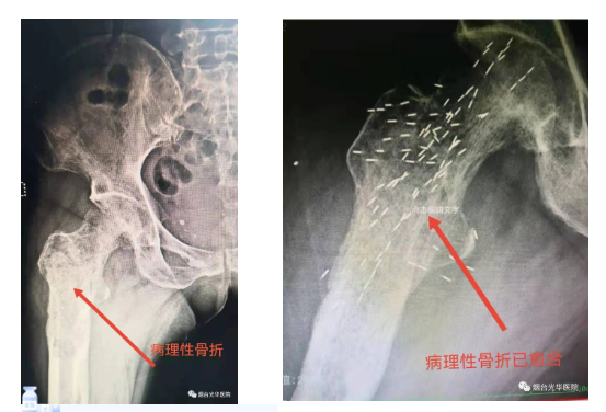 恶性骨肿瘤晚期致病理性骨折患者能走路了